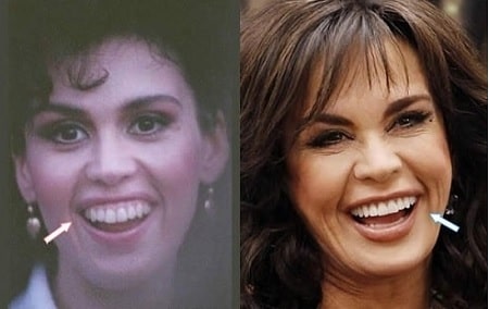 A before and after picture of Marie Osmond showing her changing gum line.